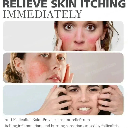 Folliculitis Psoriasis Cream Treat Inflammation Cysts Papules Acne Moisturizing Relief Dry Skin Anti Itching Antibacterial Cream