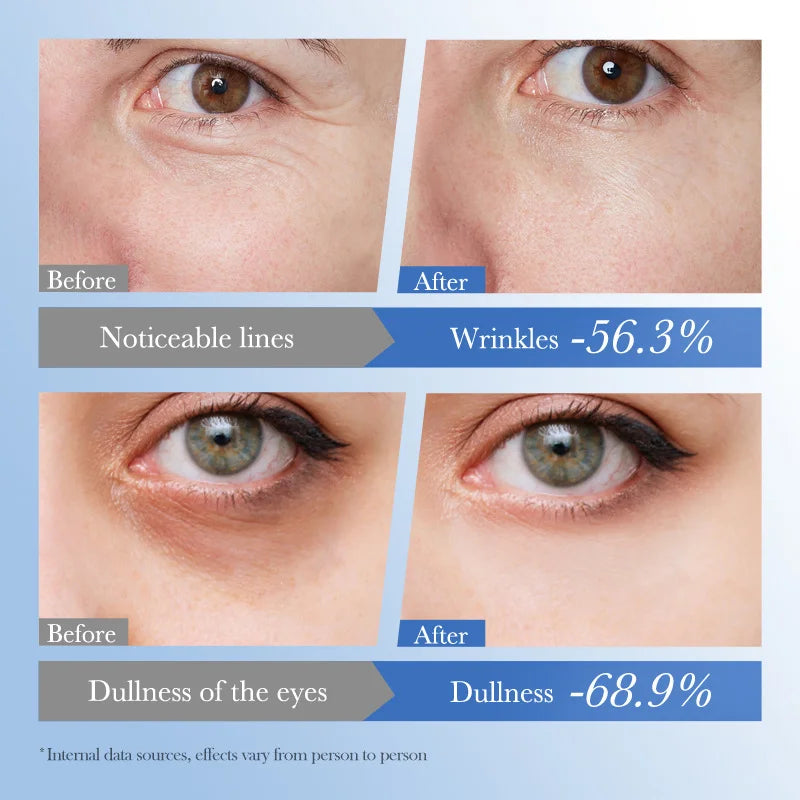 Caviar Eye Bag Removal Cream Hyaluronic Acid Anti-Wrinkle Firming Skin Fade Fine Lines Anti Dark Circle Puffiness Eye Care 20g