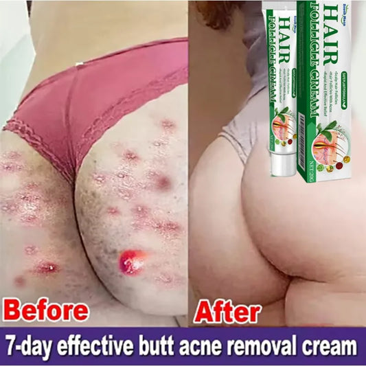 Folliculitis Psoriasis Cream Treat Inflammation Cysts Papules Acne Moisturizing Relief Dry Skin Anti Itching Antibacterial Cream